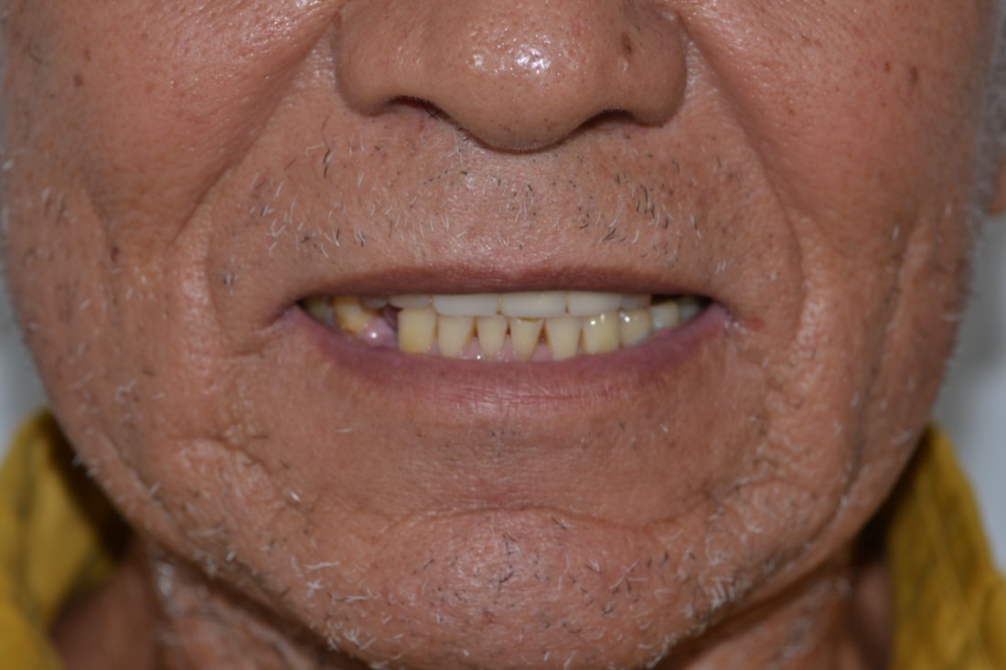 Sonrisa de paciente antes del tratamiento