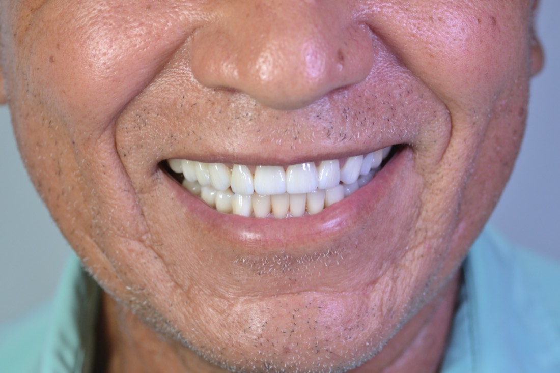 Sonrisa de paciente después del tratamiento